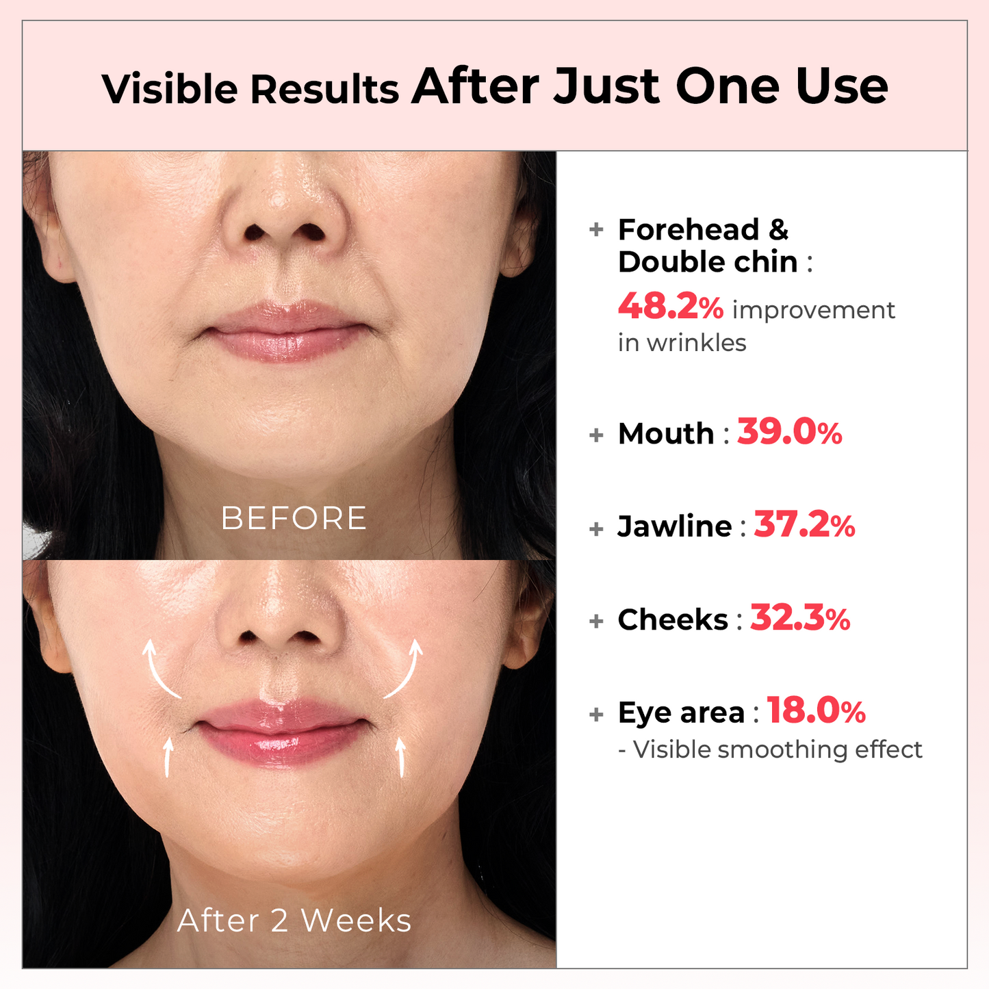 AALOK Ultra Olla - World’s first Pinching RF device